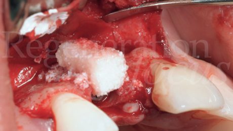 2. Dopo l’applicazione nel difetto delle particelle di Geistlich Bio-Oss®, Geistlich Bio-Oss® Collagen viene tagliato a forma di L e adattato per ottenere volume lungo il profilo.
