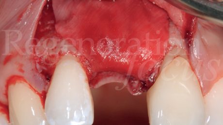 4. ll difetto viene coperto con una membrana Geistlich Bio-Gide®.