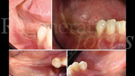 1. Situazione clinica pre-operatoria in cui si evidenzia una discreta atrofia del processo alveolare nel IV quadrante