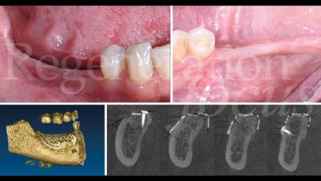 10. Guarigione clinica e radiografica a 6 mesi dall’intervento