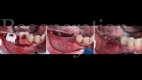12. Modifica del fenotipo tissutale mediante matrice in collagene, Geistlich Fibro-Gide®, posizionata a poncho intorno alle viti di guarigione