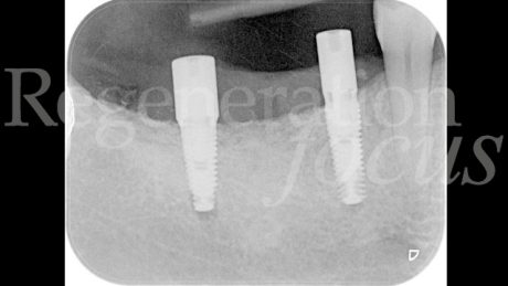13. Radiografia endorale post-operatoria