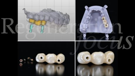 15. Progettazione e realizzazione delle corone protesiche in zirconia monolitica a connessione diretta, senza l’utilizzo di abutment protesici