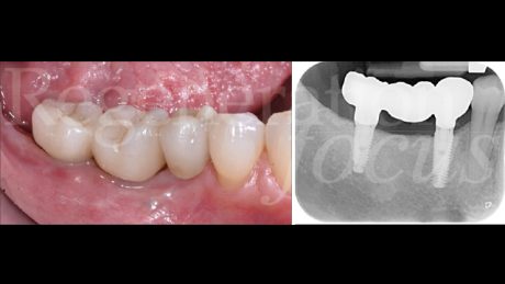 16. Situazione clinica e radiografica ad 1 anno dalla consegna protesica
