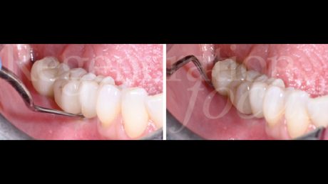 17. Raccolta della placca per analisi del microbioma peri-implantare