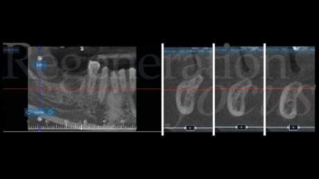 2. Situazione radiografica pre-operatoria evidenziata mediante esame CBCT