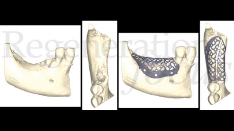 3. Progettazione digitale della mesh customizzata in titanio Yxoss CBR® Protect