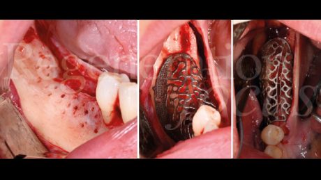 5. Perforazioni della corticale e adattamento preciso della mesh customizzata al sito ricevente