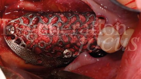 7. Fissazione della mesh con 3 viti da ostesintesi FYxoss posizionate vestibolarmente, occlusalmente e lingualmente