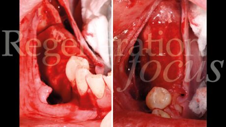 8. Copertura della mesh con una membrana riassorbibile in collagene Geistlich Bio-Gide®