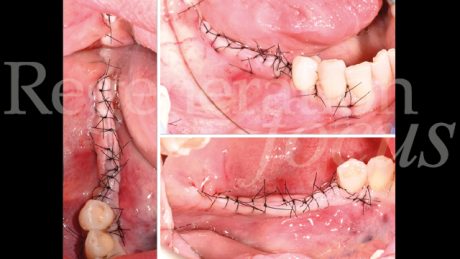 9. Chiusura per prima intenzione in assenza di tensioni mediante punti a materassaio orizzontale interni e punti staccati